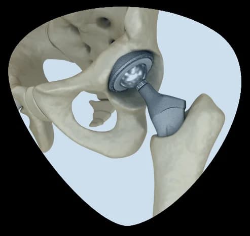 Best Hip replacement Services in jaipur Dr Anoop Jhurani