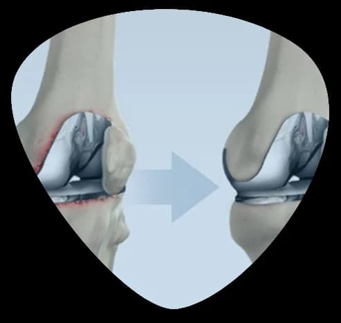 Hip replacement Services in india Dr Anoop Jhurani