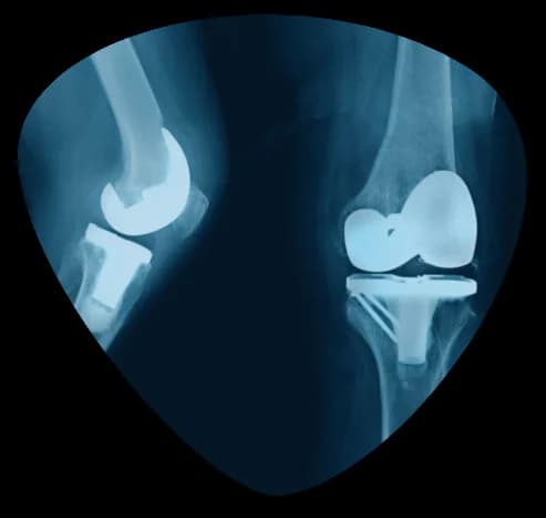 Knee replacement Services in jaipur Dr Anoop Jhurani