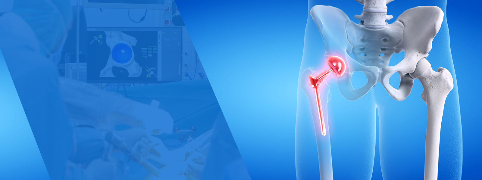 Computer Assisted Knee Replacements in jaipur india Dr. Anoop Jhurani