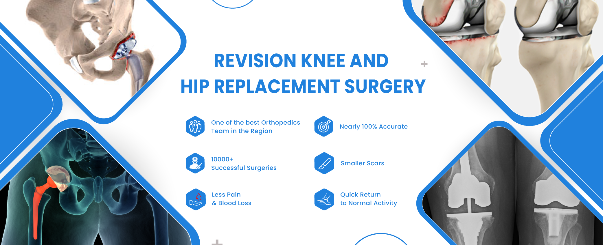 revision-surgery Revision knee and hip replacement surgery