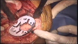 Subvastus Approach Total Knee Replacement