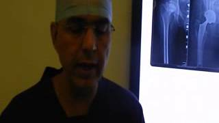 Which hip stem to choose and why? A evidence based approach by Dr. Anoop Jhurani