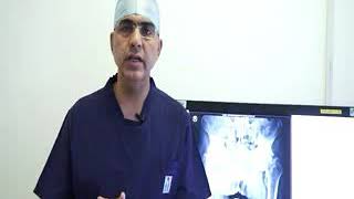 Takedown of a fused or stiff hip in Ankylosing Spondylitis