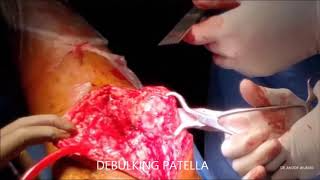 Total Knee Replacement in Femur Extraarticular Deformities by Dr. Anoop Jhurani
