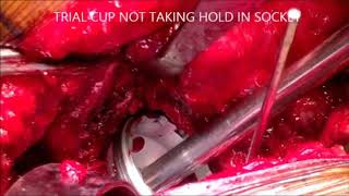 Gription revision cup and augment for post acetabular fracture THR by Dr. Anoop Jhurani