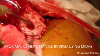 Cement in cement total hip revision for instability in elderly patient by Dr. Anoop Jhurani