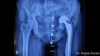 Revision Hip Replacement for Failed Protrusio Bipolar using ETO by Dr. Anoop Jhurani