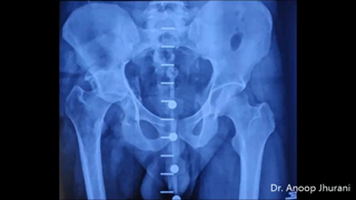 Total Hip Replacement for Neglected Posterior Fracture Dislocation by Dr. Anoop Jhurani