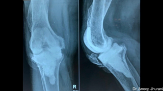 Tibial tubercle osteotomy (TTO) in Revision Knee Replacement by Dr. Anoop Jhurani