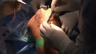 Live Knee Replacement in Rheumatoid Discussion-I