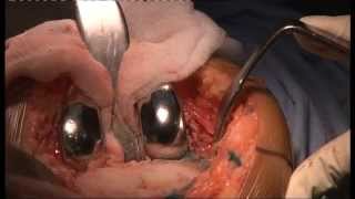 Live Knee Replacement in Rheumatoid Discussion-II