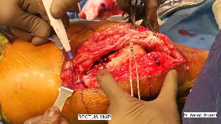 Revision knee replacement in stiff knee post spacer by Dr Anoop Jhurani
