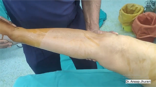 Conversion of fibrous ankylosed knee to TKR