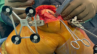 Correction of 20 Fixed flexion deformity with Mako Robotics