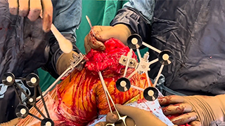Correction of severe FFD with MAKO Robotics